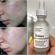 The Ordinary - Niacinamide 10% + Zinc 1% - 30ml